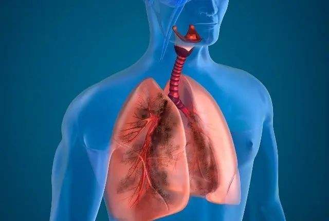 肺部感染（含新冠肺炎-Covid-19）影像学（CT）表现