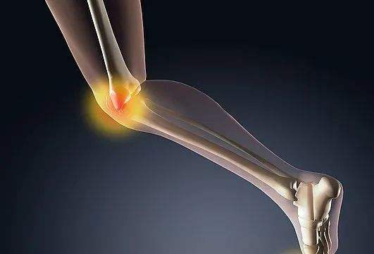 平衡松解术在膝关节的应用
